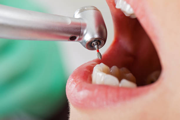 Best Broken or Cracked Tooth Emergency Dentist in Clearfield, UT